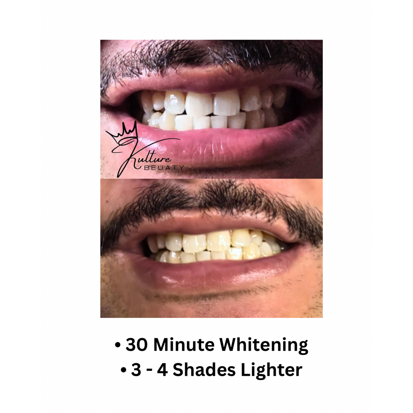 before and after whitening