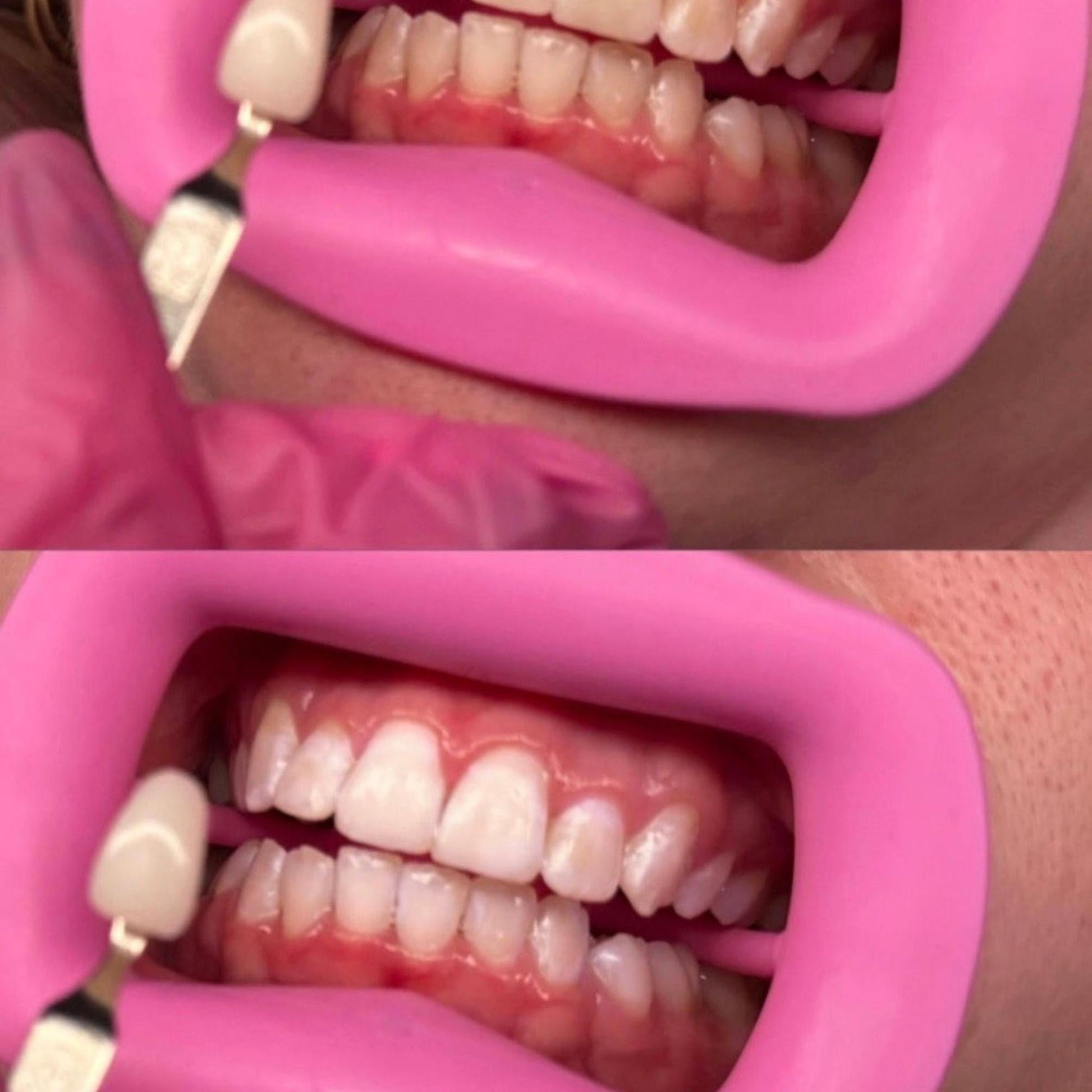 before and after teeth