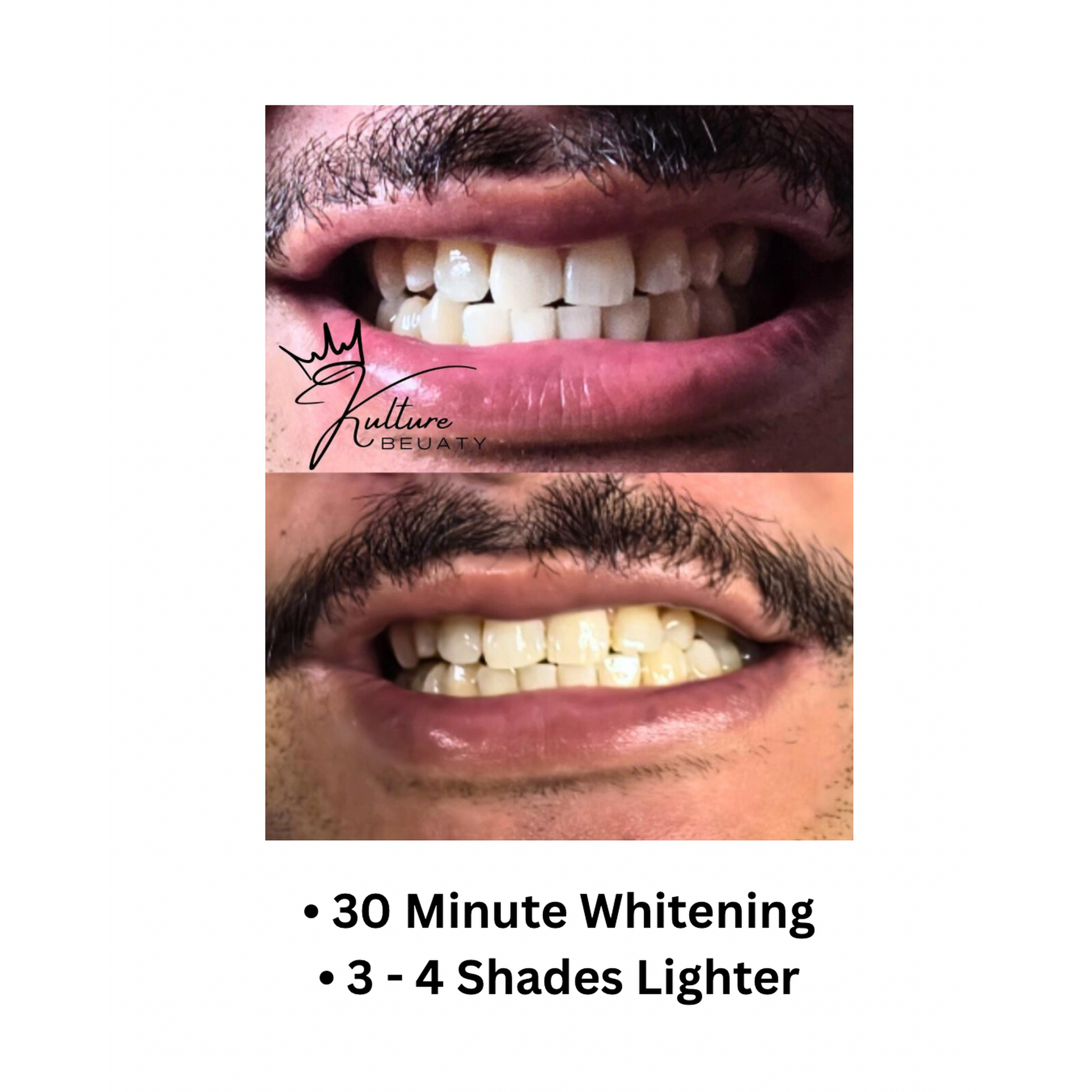 before and after whitening